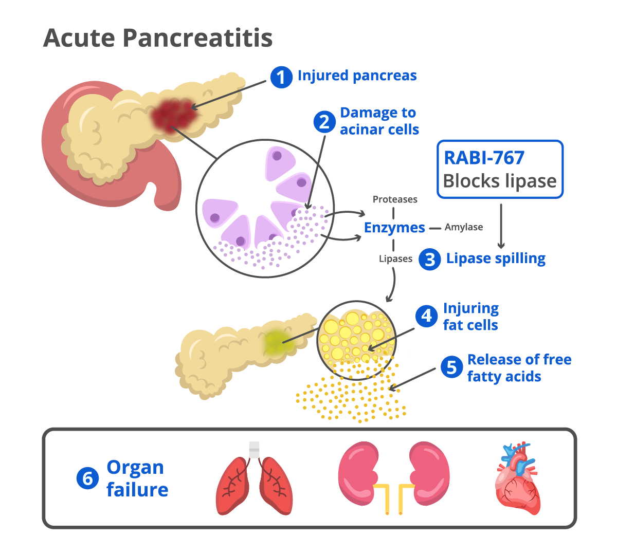 Arrivo_graphic_RABI_767_Revised Graphic showcasing RABI-767 role in acute pancreatitis